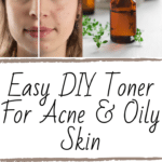Easy DIY Toner for Acne and Oily Skin